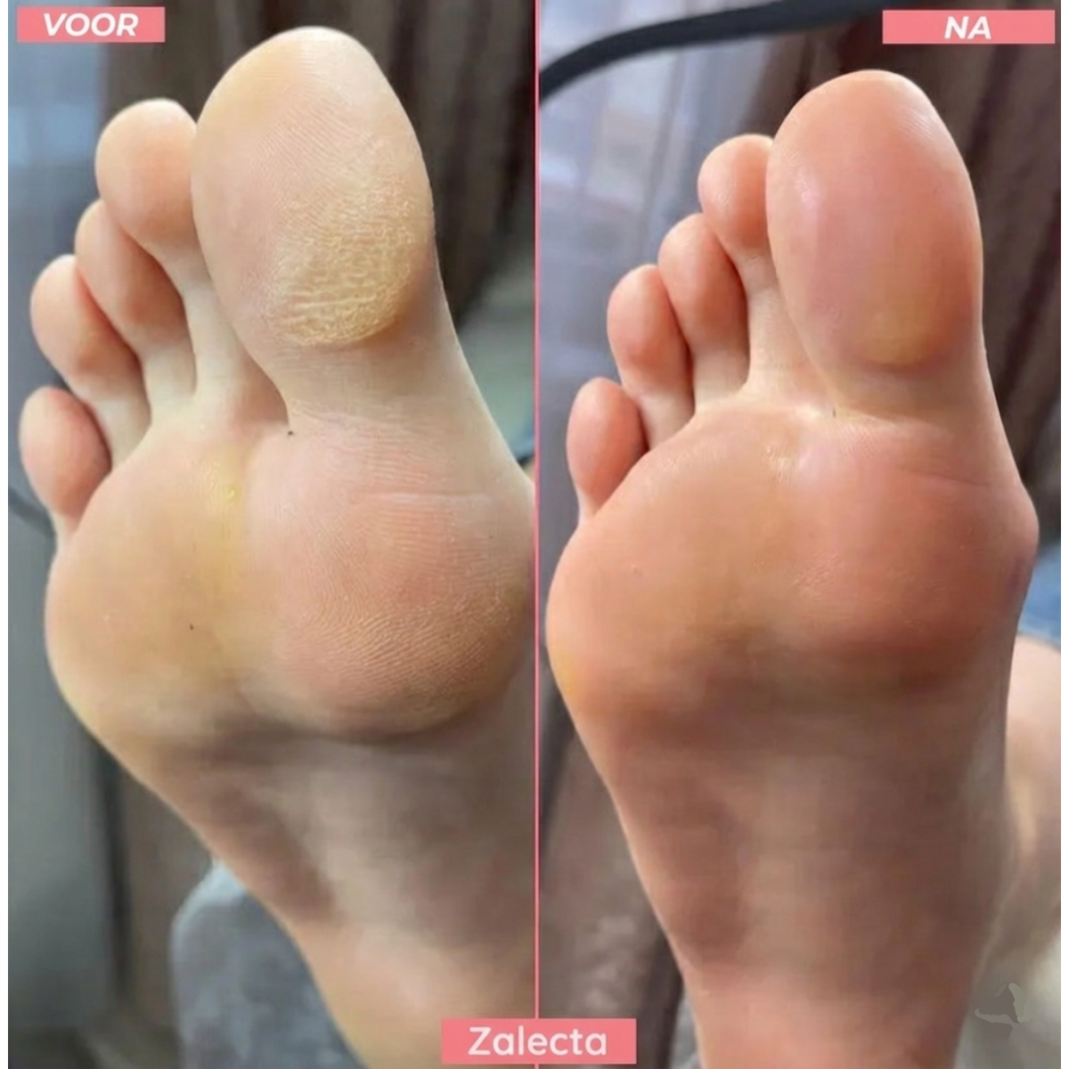 Zalecta FootGlow Elektrische Eeltverwijderaar - Oplaadbare Voetvijl voor Zachte Voeten