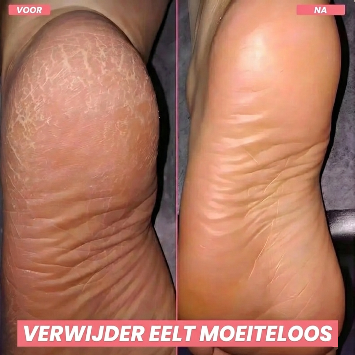 Zalecta FootGlow Elektrische Eeltverwijderaar - Oplaadbare Voetvijl voor Zachte Voeten