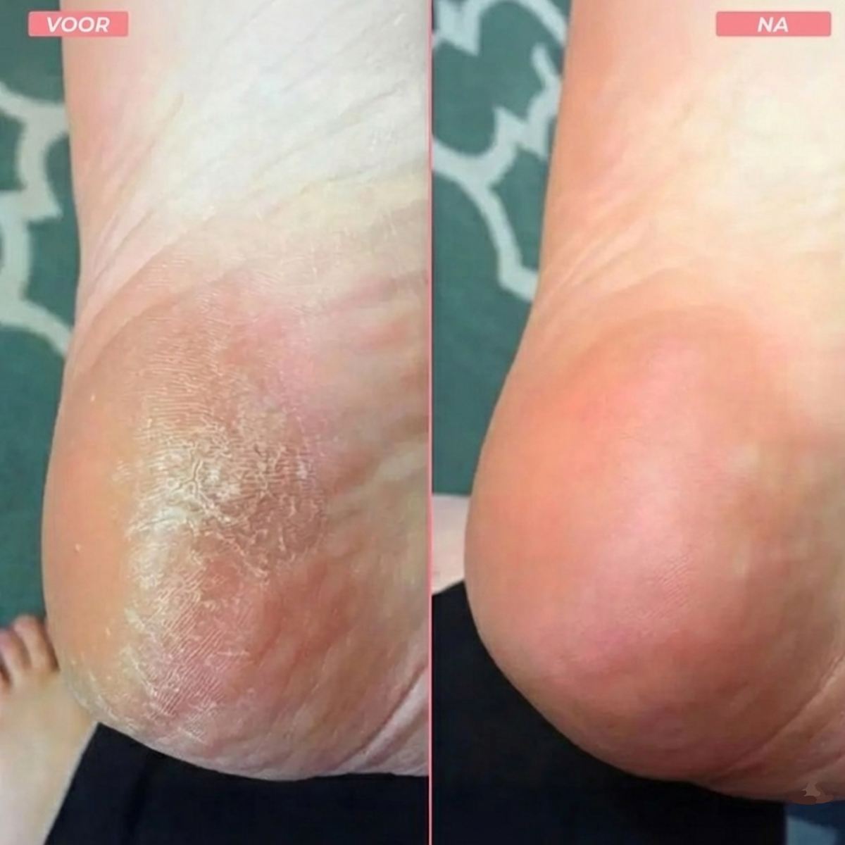 Zalecta FootGlow Elektrische Eeltverwijderaar - Oplaadbare Voetvijl voor Zachte Voeten