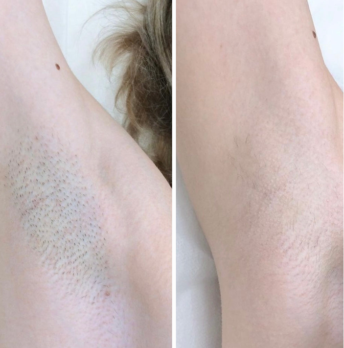 Elysia Ladyshave Dames - Draadloos Elektrisch Scheerapparaat voor Gevoelige Huid